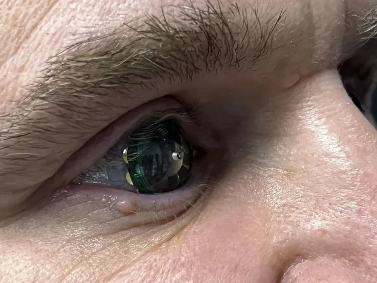 closeup of eye with contact lens containing electronic components e