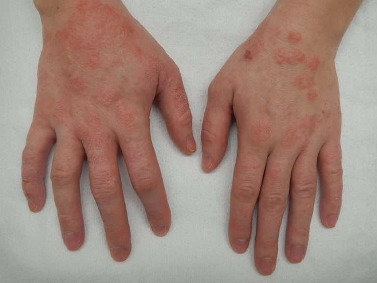 Dermatitis e